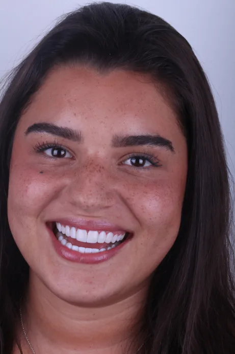 After: Brighter, fuller smile