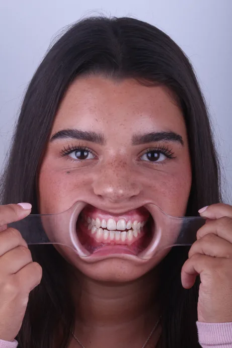 Before: Brighter, fuller smile