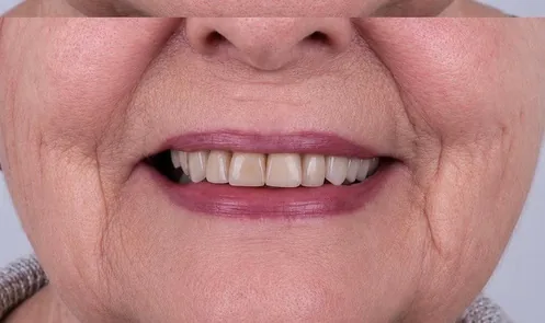 After: Chipped front teeth repaired