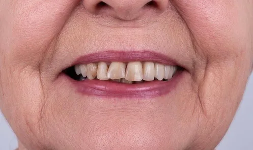 Before: Chipped front teeth repaired