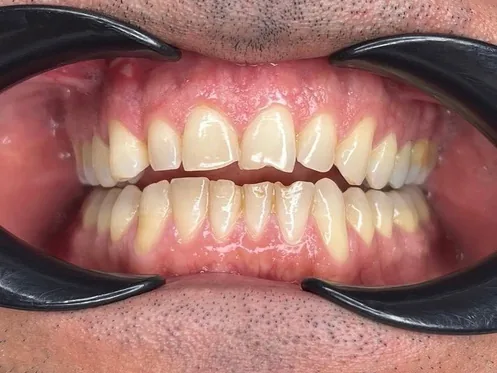 Before: Complete smile renewal