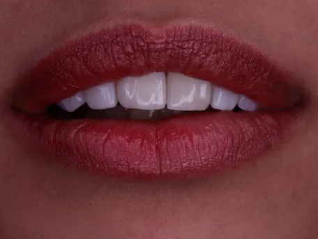 After: A softer, brighter smile