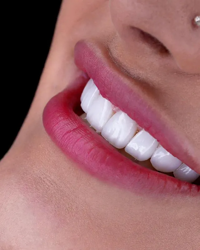 Smile result by Dr. Leila Sahabi, cosmetic dentist in Dubai