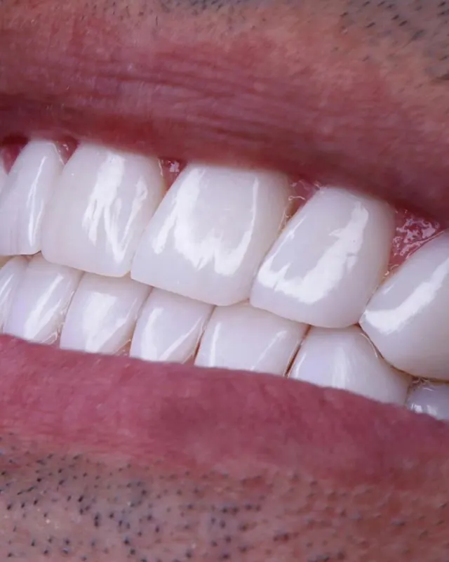 Smile result by Dr. Leila Sahabi, cosmetic dentist in Dubai