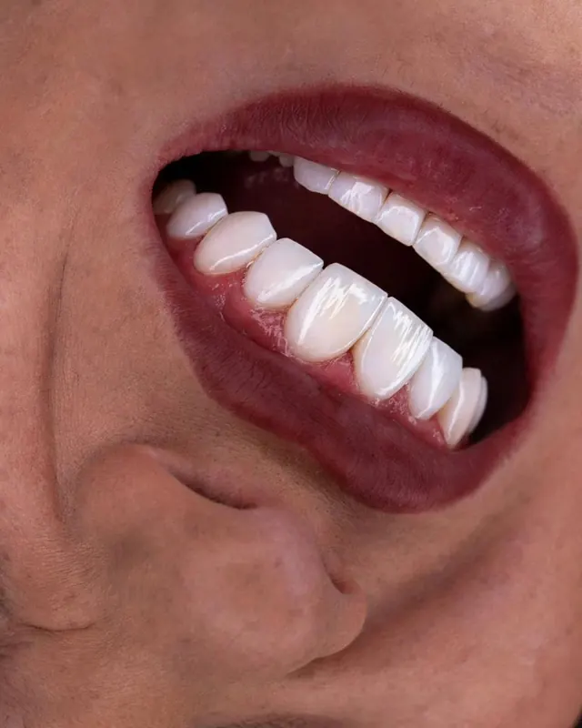 Smile result by Dr. Leila Sahabi, cosmetic dentist in Dubai