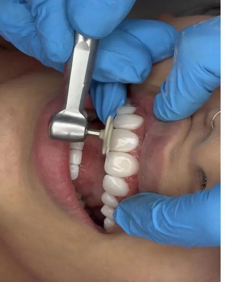 Smile makeover and Digital Smile Design in Dubai