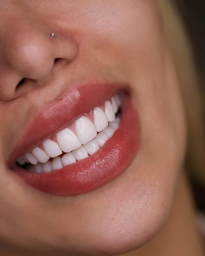 Professional teeth whitening in Dubai